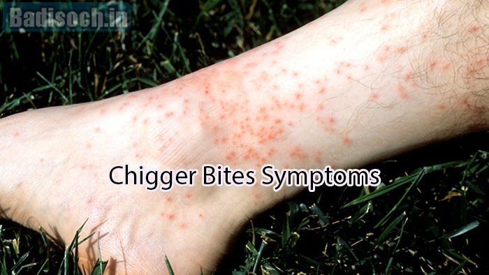 Chigger Bites Symptoms